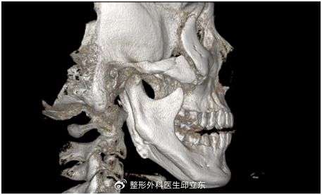 邱立东院长科普：下颌角截骨后线条不流畅怎么办？